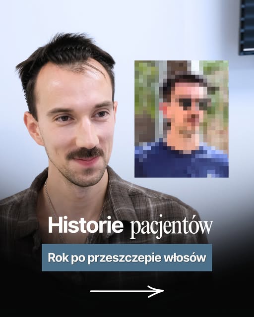 Co może wydarzyć się w rok?

U chłopaków, którzy zdecydowali się na przeszczep włosów w Turcji wydar