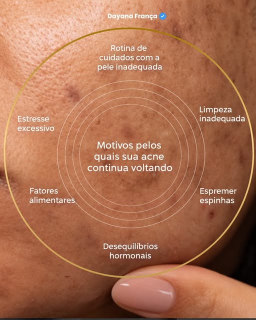 Espinhas não aparecem por acaso! 
Quando surgem repetidamente em certas áreas do corpo, elas não est