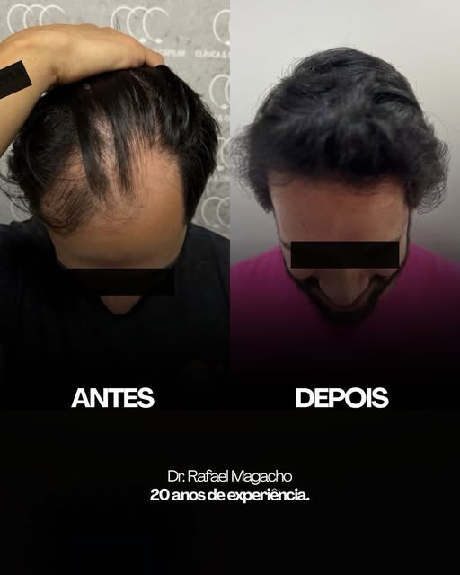 A calvície é uma queixa constante nos consultórios e a busca por soluções naturais só cresce. 
Você,