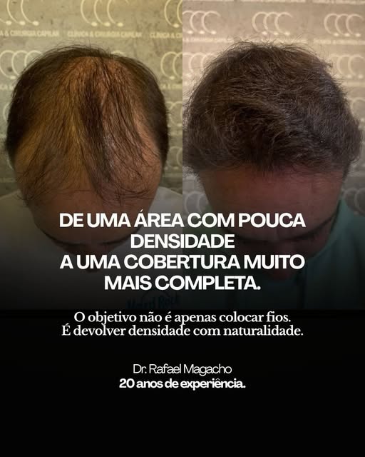 Não é apenas sobre ter mais cabelo. É sobre voltar a se reconhecer no espelho.

Esse é o resultado d
