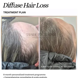 Hair regrowth doesn't happen overnight... but it can happen 🌱
Six months. One personalised treatmen