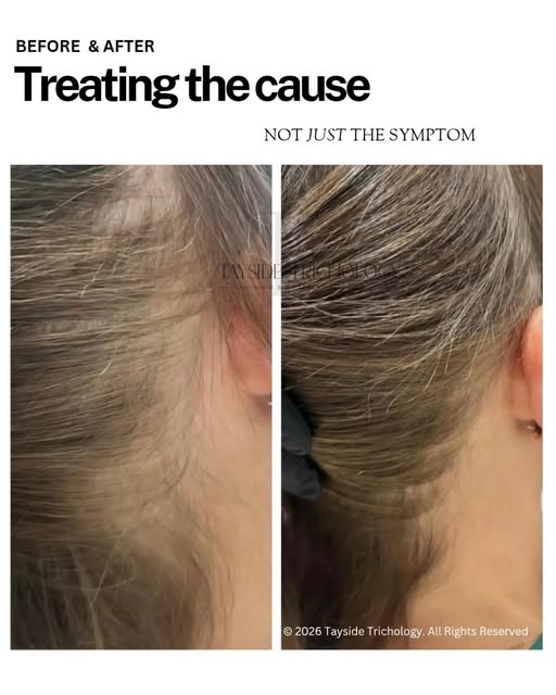Hair loss is rarely just about the hair.

For this client, progress began when we looked beyond the 