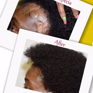 🌿🌱Alopecia is NOT Permanent Reclaim your hair loss in 3-6 Months GUARANTEED🌿🌿🌿
Book your FREE C