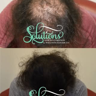 Struggling with Hair Shedding or Thinning Hair? Our holistic hair restoration clinic uses natural th