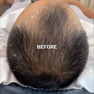 Scalp MicroPigmentation (The Cosmetic Hair Tattoo) by Chris Pritchard in Regina, Sk — www.microbarbe