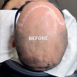 Scalp MicroPigmentation (The Cosmetic Hair Tattoo) by Chris Pritchard in Regina, Sk — www.microbarbe