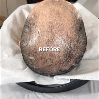 Scalp MicroPigmentation (The Cosmetic Hair Tattoo) by Chris Pritchard in Regina, Sk — www.microbarbe