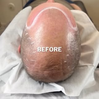 Scalp MicroPigmentation (The Cosmetic Hair Tattoo) by Chris Pritchard in Regina, Sk — www.microbarbe
