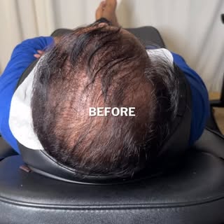 Scalp MicroPigmentation (The Cosmetic Hair Tattoo) by Chris Pritchard in Regina, Sk — www.microbarbe