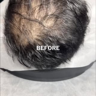 Scalp MicroPigmentation (The Cosmetic Hair Tattoo) by Chris Pritchard in Regina, Sk — www.microbarbe