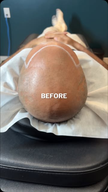 Scalp MicroPigmentation (The Cosmetic Hair Tattoo) by Chris Pritchard in Regina, Sk — www.microbarbe