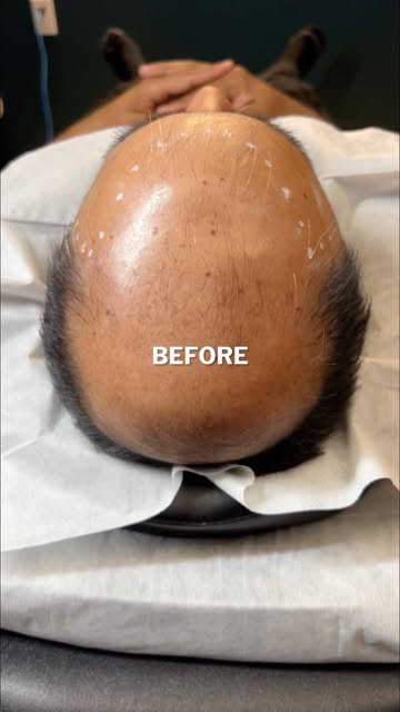 Scalp MicroPigmentation (The Cosmetic Hair Tattoo) by Chris Pritchard in Regina, Sk — www.microbarbe