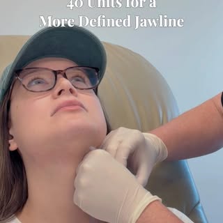 The Nefertiti Lift is a Botox treatment designed to soften the downward pull of the platysma, the br