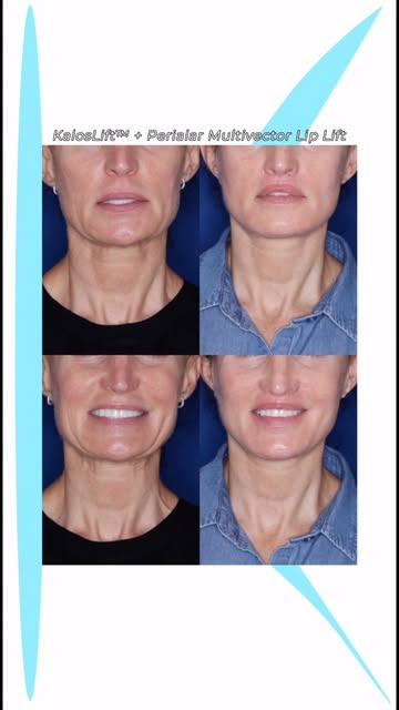 Facial aging rarely happens in just one area. The KalosLift™ and Perialar Multivector Lip Lift addre