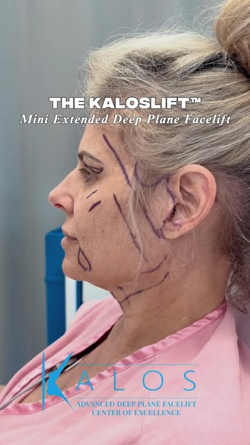One of the biggest misconceptions about facelift surgery is that it only treats the lower face and n