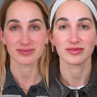 You’ll see in her after photo that her skin just looks healthier. It’s brighter, more even, more awa