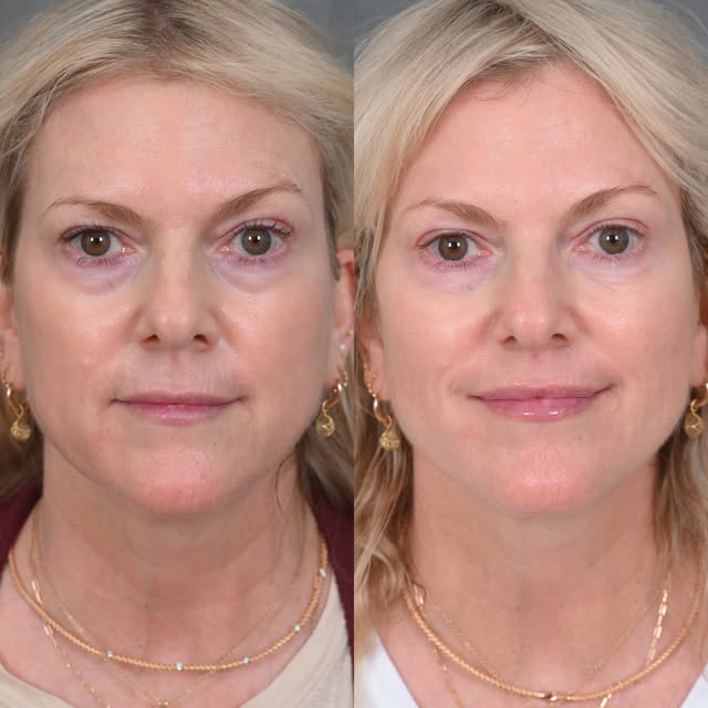 All we did here was Botox.

We took some of the strain out of her face, re-set her eyebrows, softene