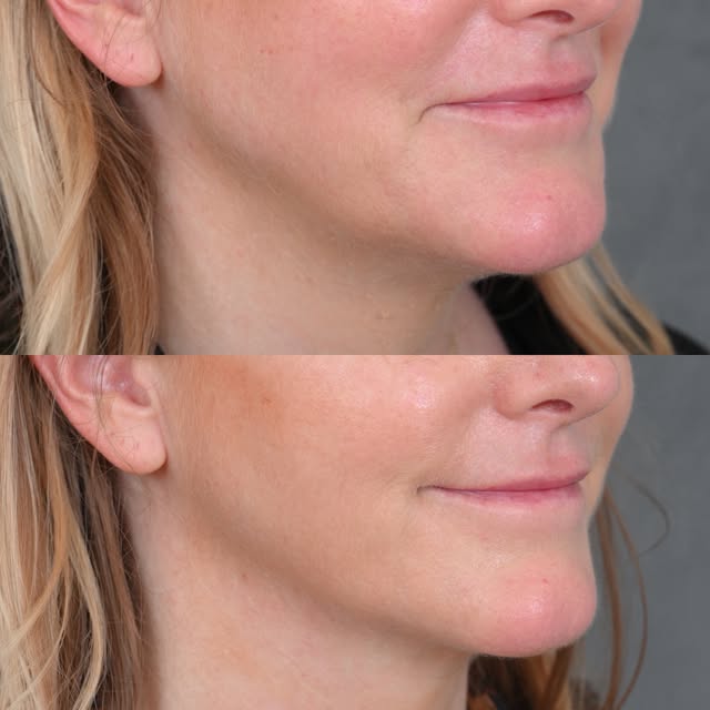 Look at the change in the vector of the oral commissures, the smoother jawline, and the more elegant
