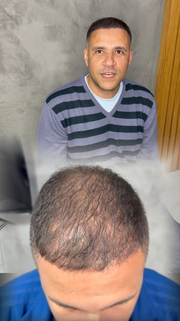 Diga Adeus a Calvície em horas! 

Micro Capilar Ultra-Realista 4 D 🔥
______________________________