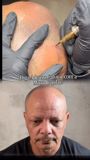 Diga Adeus a Calvície em horas! 

Micro Capilar Ultra-Realista 4 D 🔥
______________________________
