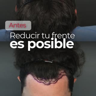 Reducir el tamaño de tu frente y lograr un resultado 100% natural sí es posible. 🚀

Acompáñame a ve
