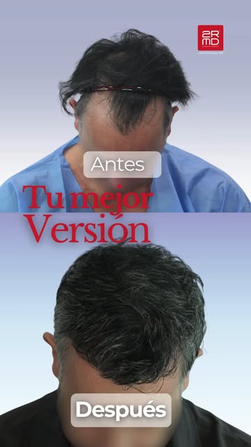 El diseño de una nueva línea de implantación requiere precisión milimétrica, técnica y un profundo c