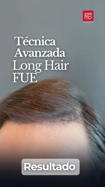 Descubre cómo recuperar tu pelo sin rapar tu cabeza con la técnica Long Hair FUE. 👇

En 2RMD sabemo