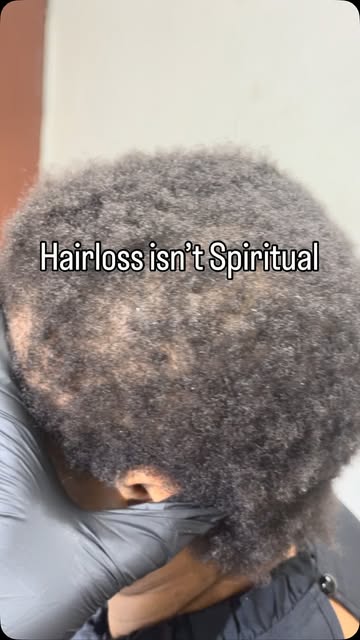 HAIR LOSS IS NOT SPIRITUAL.

Of course, we live in Nigeria, where spiritual explanations are deeply 