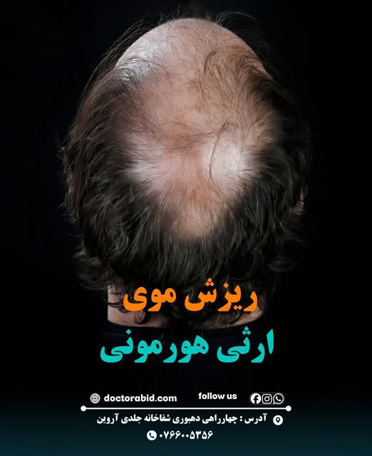 ریزش موی ارثی هورمونی

ریزش موی ارثی هورمونی یکی از شایع‌ترین انواع ریزش مو است که هم در مردان و هم 