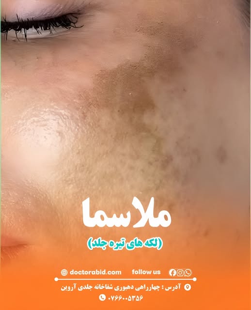 لکه‌های روی چیست؟

لکه‌های روی یا ملاسما، لکه‌های قهوه‌ای روشن تا قهوه‌ای تیره هستند که بیشتر در قسم
