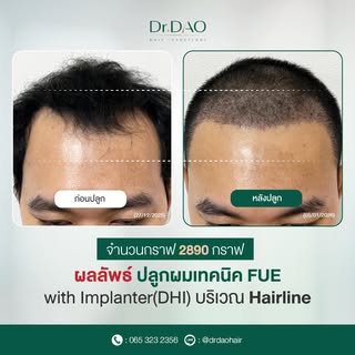 รีวิวหลังจากปลูกผมไปแล้ว9วัน ตอนนี้บริเวณที่ปลูกได้มีการถอดสะเก็ดเรียบร้อยแล้ว หลังจากนี้จะมีการหลุด