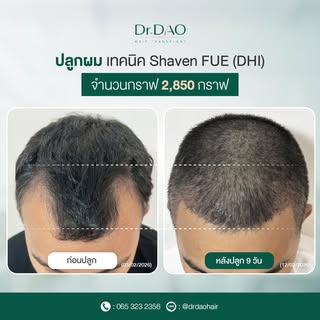 ปลูกผมผมเต็มร่องตัวM เมื่อแนวเว้าผมหายไป ความมั่นใจก็กลับมา😊🤍

ปลูกผมปรับกรอบหน้า เติมแนวผมให้ดูหน