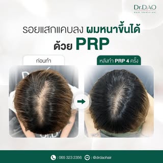 PRP (Platelet-Rich Plasma) เป็นหนึ่งในหัตถการที่ใช้ดูแลสุขภาพเส้นผมและหนังศีรษะค่ะ 😻

เคสในภาพเป็นผ