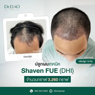 รีวิวหลังจากปลูกผมไปแล้ว10วัน ด้วยเทคนิคการเจาะแบบFUEและปลูกด้วยปากกานำปลูกDHI เทคนิคนี้แบบผมสั้น ทา