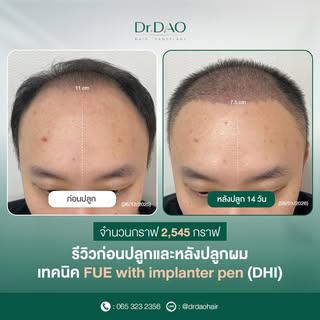 จากภาพเป็นการปลูกผมแก้ไขปัญหาผมล้านที่เริ่มร่นขึ้นไปถึงกลางศรีษะ และปรับระดับแนวผมให้ต่ำลงมาเพื่อให้