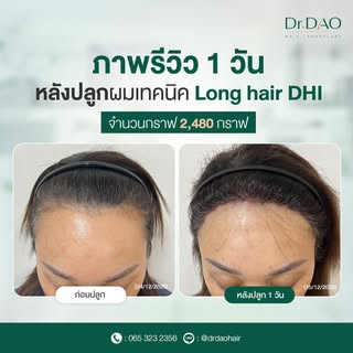 ไรผมแบบไหน เราก็ทำให้ได้ 😍

ปลูกผมปรับกรอบหน้า เติมแนวผมให้ดูหนาแน่น ด้วยเทคนิค Long Hair DHI เคสนี