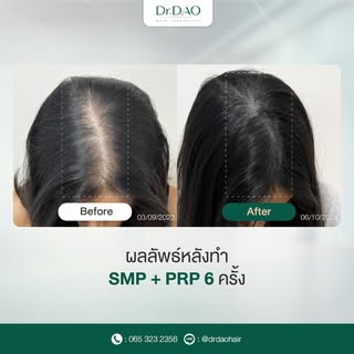 การดูแลควบคู่ทั้งด้านสุขภาพและความงามให้กับหนังศีรษะ ช่วยให้ผลลัพธ์ดูชัดเจนยิ่งขึ้น 🫶🏼

เคสนี้คุณผ