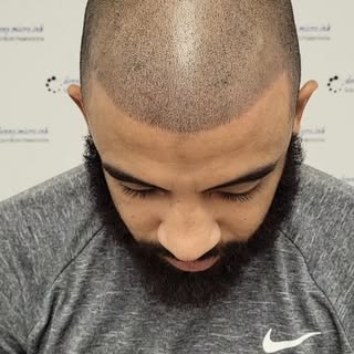 Fresh Ink! Scalp Micropigmentation, a hair loss solution. 
#scalpmicropigmentation #smp #smpartist #