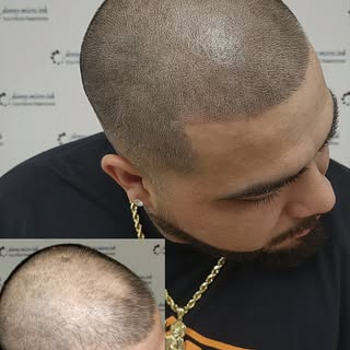 Scalp Micropigmentation Before & After. SMP adds density to thinning/balding hair  for a more even, 