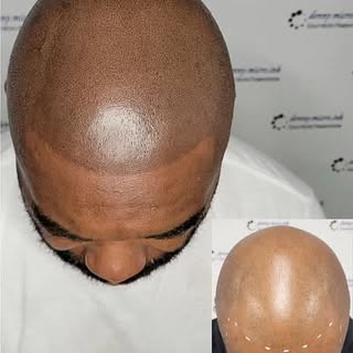 Scalp Micropigmentation a hair loss solution! New hairline in effect! 📍Houston 🇨🇱
#scalpmicropigm