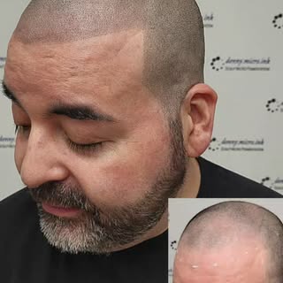 Scalp Micropigmentation Before & After!
#scalpmicropigmentation #smp #hairlosssolution #hairlinerest