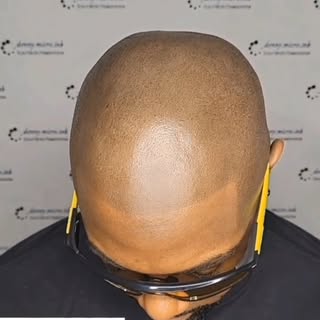 Scalp Micropigmentation, new hairline in effect!
Find out how SMP can help you too! 
DM for quotes �