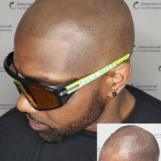 Scalp Micropigmentation! A hair loss solution! Serving Houston area 🇨🇱
#hairtattoo #scalpmicropigm