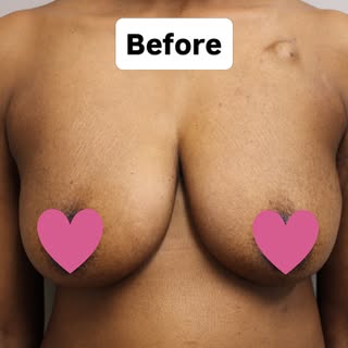 Breast reconstruction is a big part of my practice. These patients become very special to me 💕🙏

I
