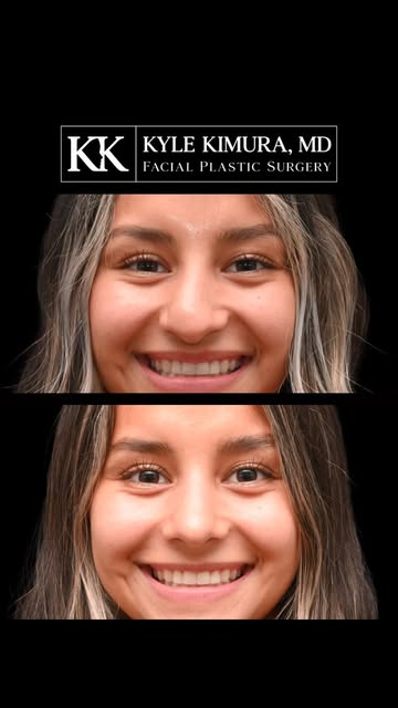 Only 6 weeks postop and already looking amazing

So happy for this wonderful patient, who initially 