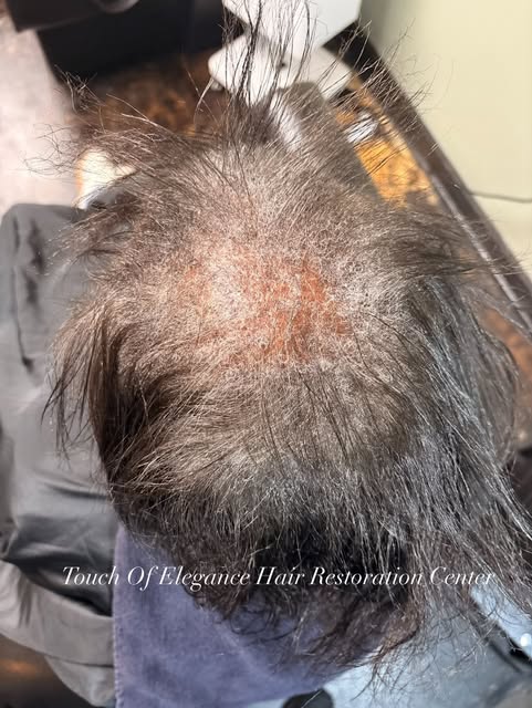 💙 SEPTEMBER IS ALOPECIA AWARENESS MONTH 

Hair loss doesn’t always happen overnight. Sometimes the 