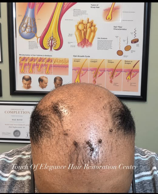September is Alopecia Awareness Month 💙

Hair loss can look different for everyone, and sometimes w