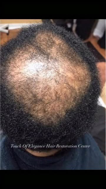 ✨ HAIR RESTORATION RESULTS ✨

This is why I tell my clients: hair restoration is a process, not an o