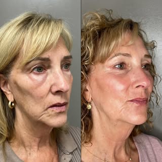 Beautiful, refined, and natural ✨

This is just 3 months after lower blepharoplasty combined with la