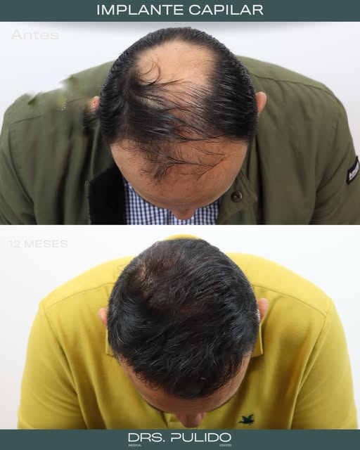 Restauración completa con resultados naturales 👨‍⚕️ tu proceso de implante capilar en manos experta